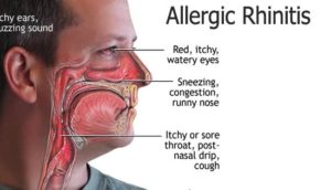 nasal allergy - allergic rhinitis