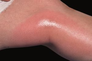 Insect Sting Allergy  Large Local Reaction