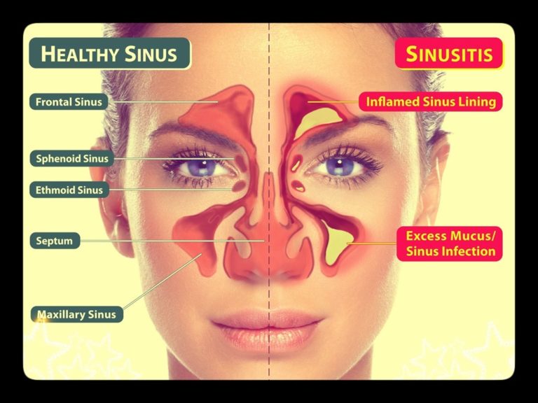 Aashwas sinusitis treatment by a specialist team of ent specialist