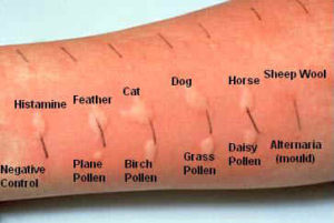 Skin Prick Test